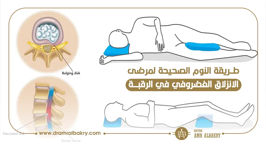 طريقة النوم الصحيحة لمرضى الانزلاق الغضروفي في الرقبة 