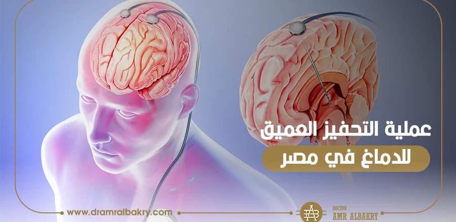 عملية التحفيز العميق للدماغ في-مصر