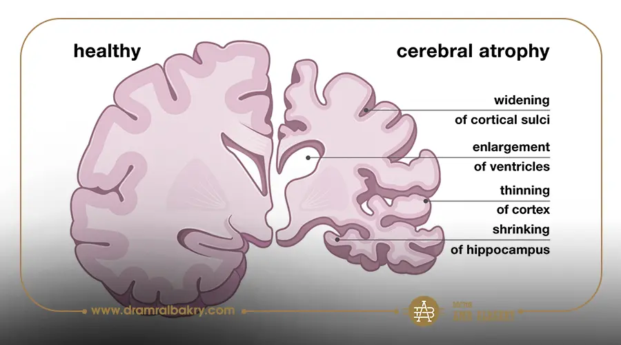افضل دكتور لعلاج ضمور المخ