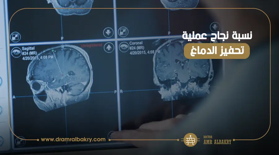 نسبة نجاح عملية تحفيز الدماغ