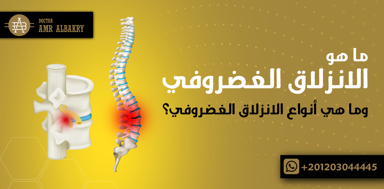 أنواع الانزلاق الغضروفي