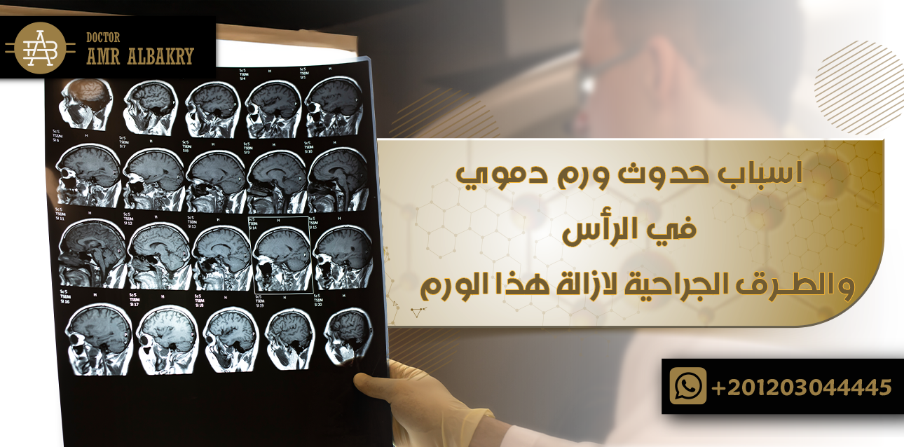 ورم دموي في الرأس