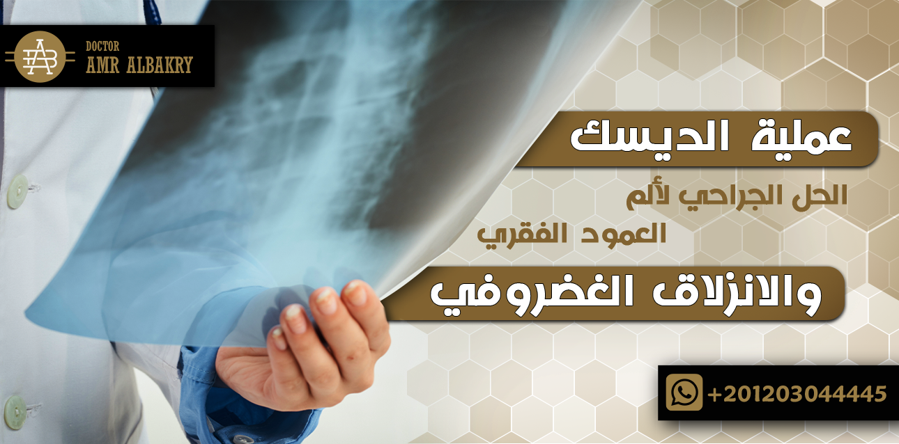 عملية الديسك