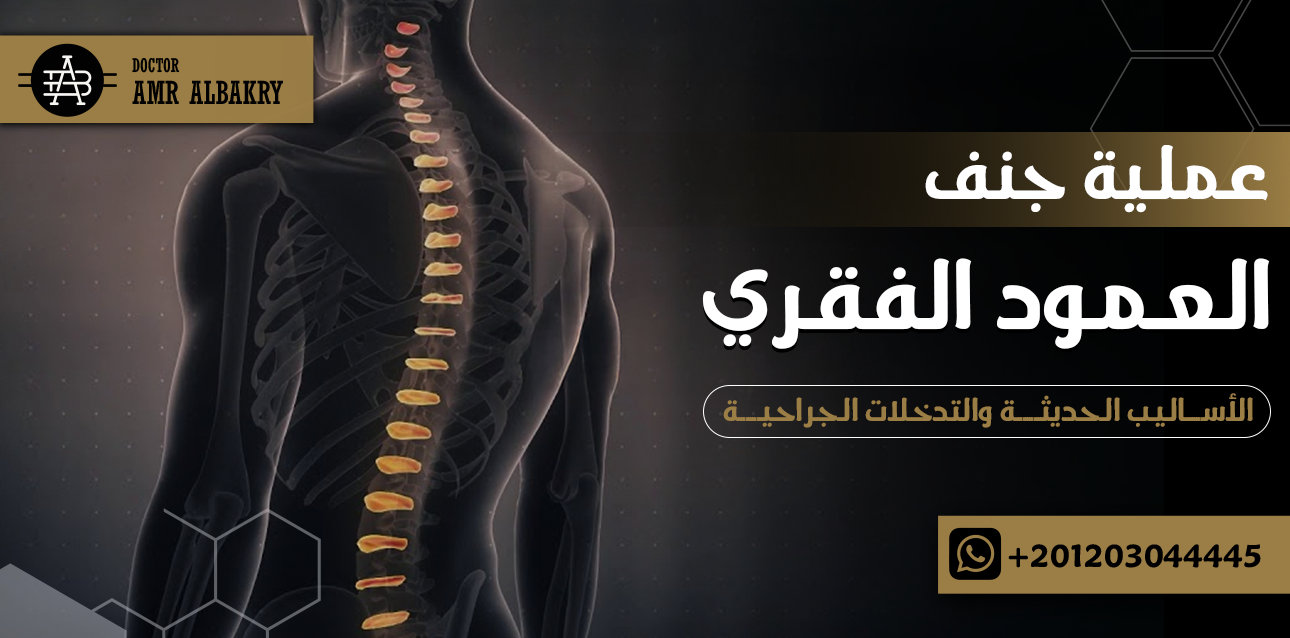 عملية جنف العمود الفقري