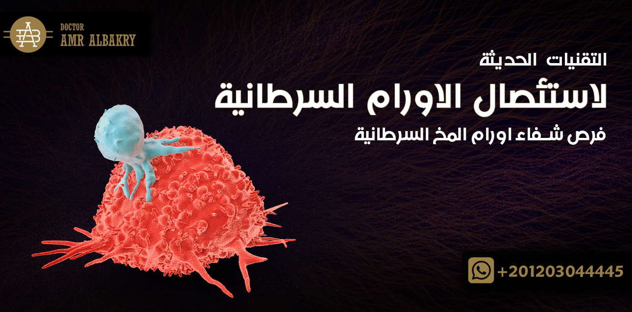 استئصال الاورام السرطانية