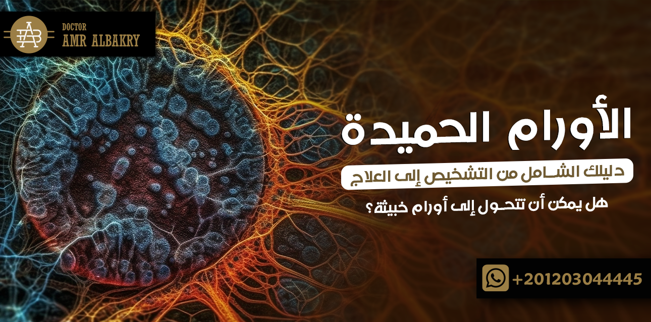 الأورام الحميدة