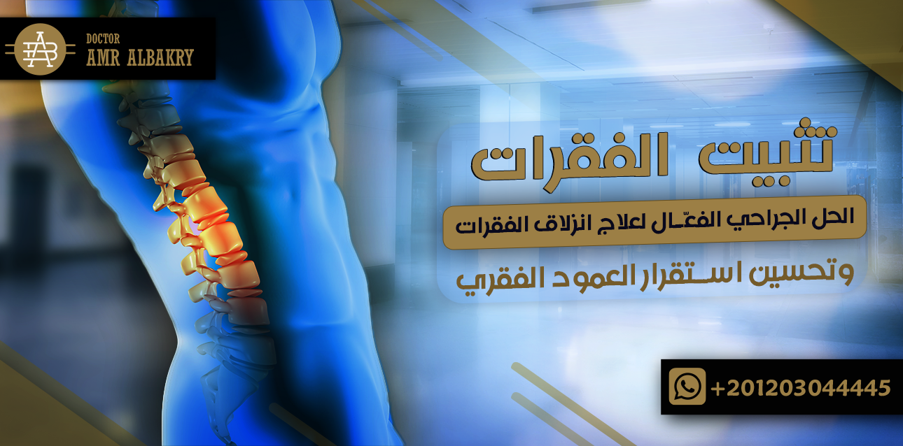 تثبيت الفقرات