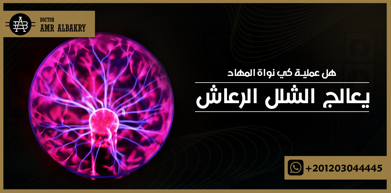 هل عملية كي نواة المهاد علاج الشلل الرعاش